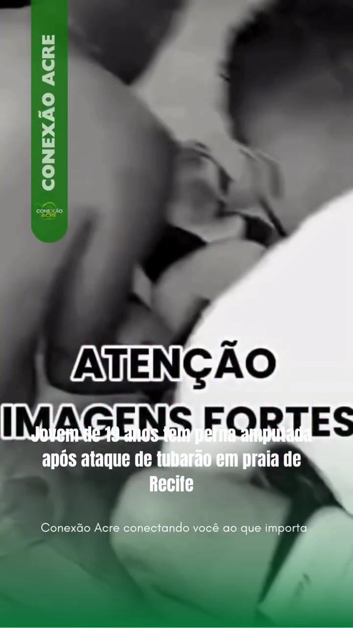 Jovem de 19 anos tem perna amputada após ataque de tubarão em praia de Recife